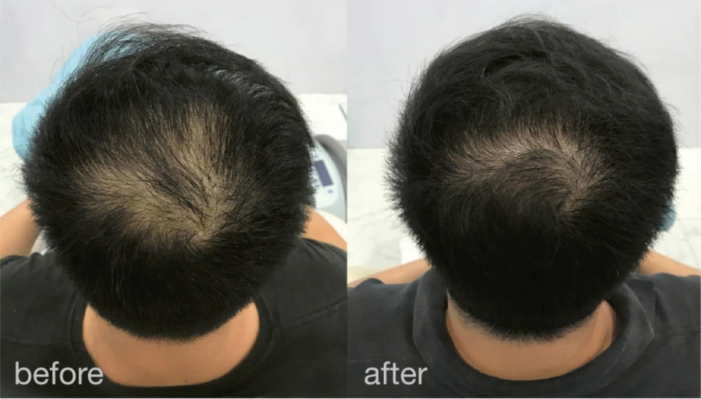 Fotona HairRestart