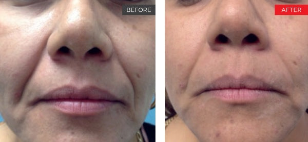 Fotona 4D/5D Facelift & Hudoppstramning