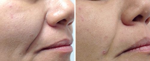 Fotona 4D/5D Facelift & Hudoppstramning