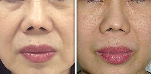 Fotona 4D/5D Facelift & Hudoppstramning