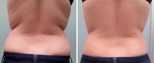 Fotona Tightsculpting