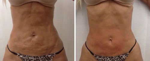 Fotona Tightsculpting