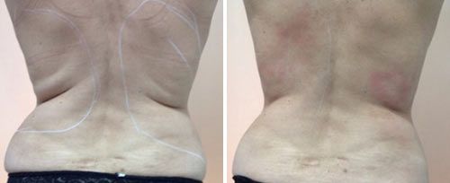 Fotona Tightsculpting